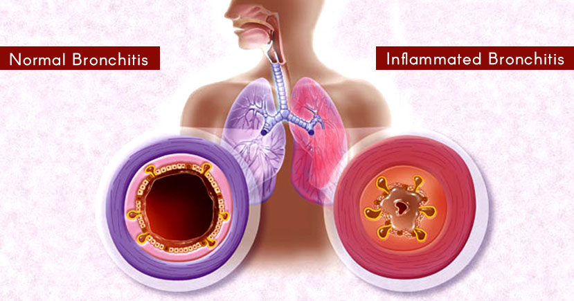 inflamation due to bronchitis